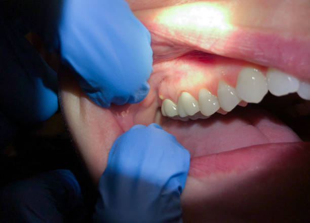 Best Emergency Wisdom Tooth Extraction in Adelphi, MD